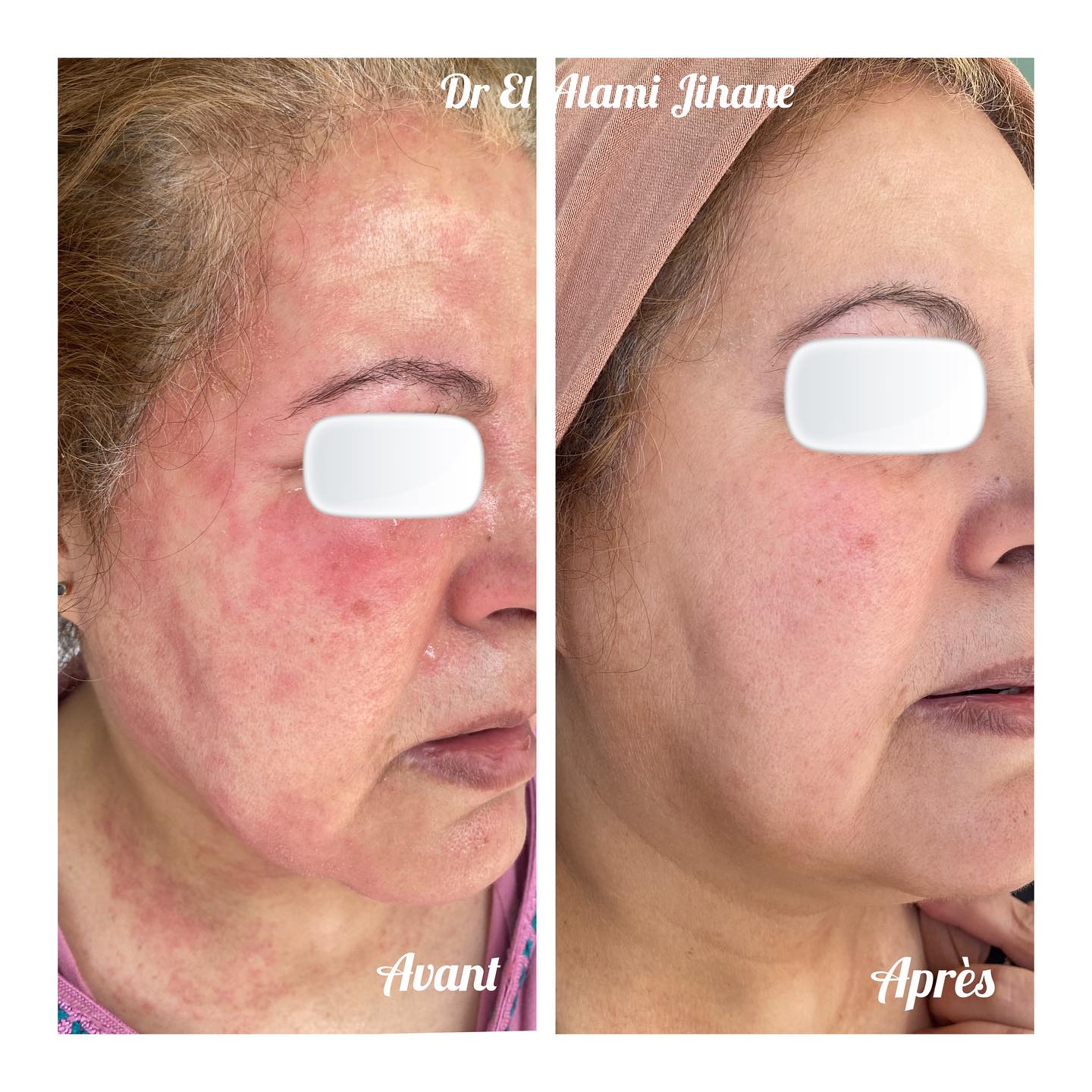 Résultat traitement peau Marrakech 1