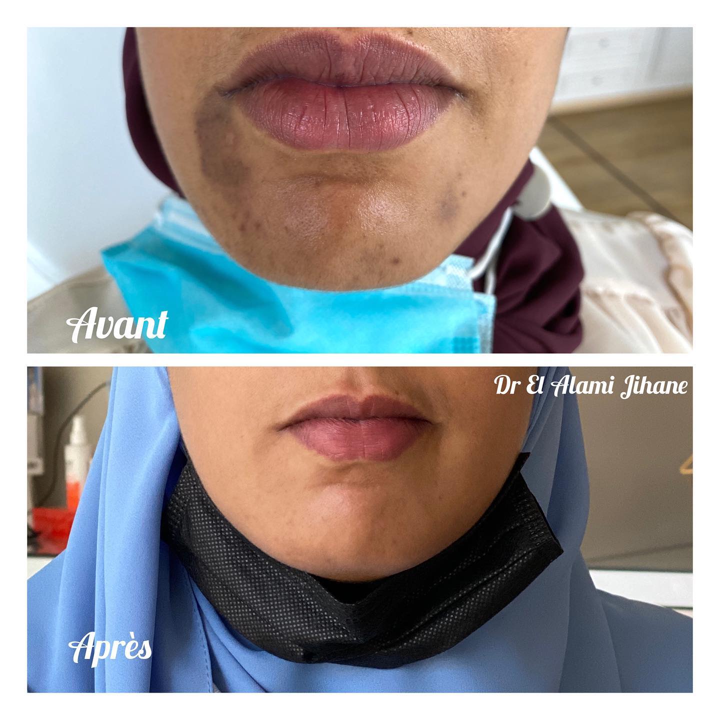 Résultat traitement peau Marrakech 3