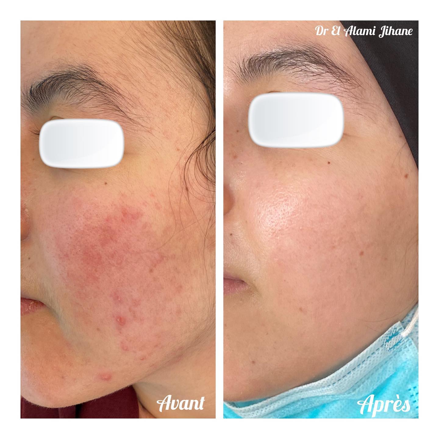 Résultat traitement peau Marrakech 5